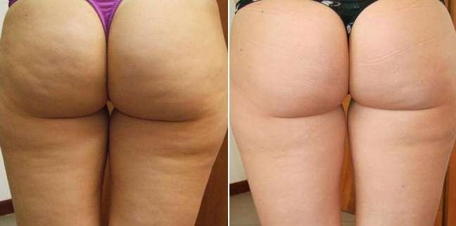 crema anticellulite uvarò opinioni crema anticellulite uvarò opinioni